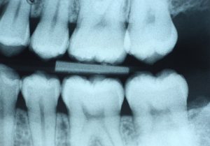 salem digital dental xray