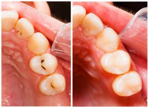 White Fillings in Salem